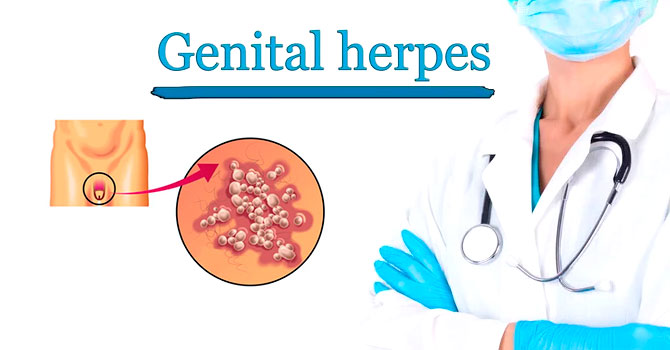 Genital herpes - Symptoms
