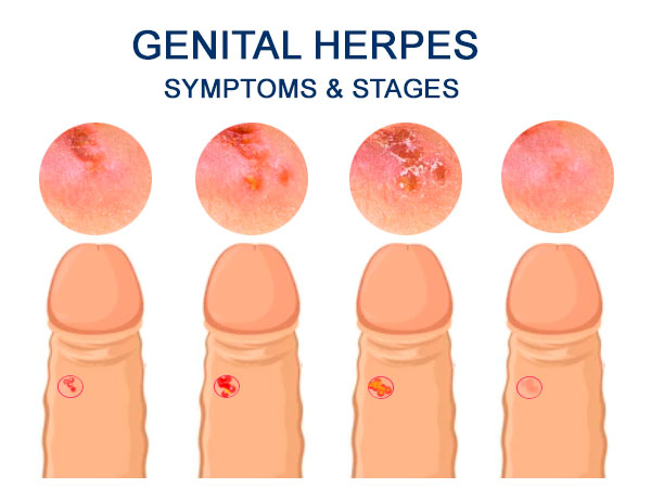Genital Herpes Symptoms & Stages